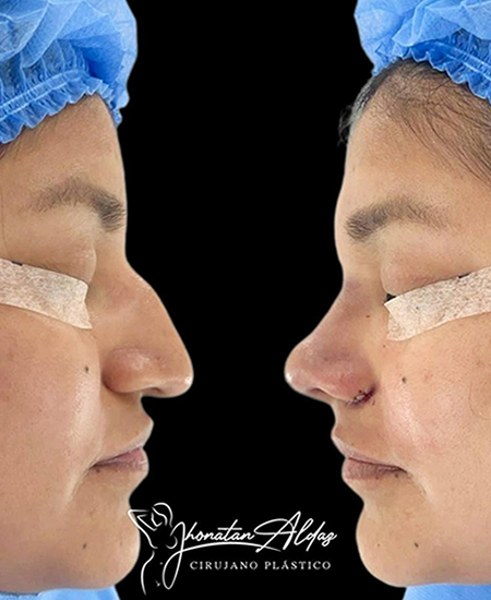 RINOPLASTIA-ULTRASONICA-GUAYAQUIL